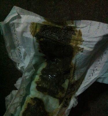 大便变黑的原因及应对方法（黑便可能暗示了这些健康问题，你需要知道！）