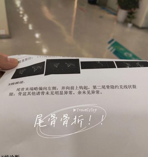 尾巴骨裂的饮食护理指南（合理饮食加速尾巴骨裂康复）