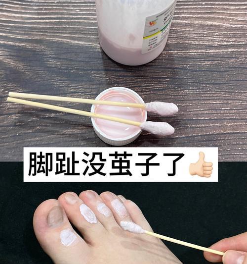 以脚趾消炎为主题的文章（有效缓解脚趾炎症的方法及注意事项）
