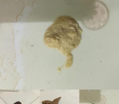 以又屙又呕的身体状况及可能原因分析（揭秘又屙又呕的健康隐患，科学预防与治疗方法）