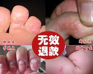 治疗狗尾巴烂的药物和方法详解（选择正确的药物是关键，教你如何解决狗尾巴烂问题）