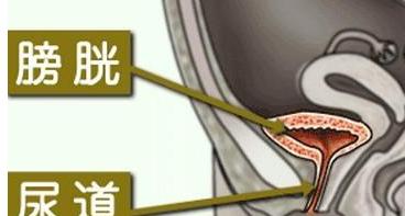膀胱裂了，症状如何？（了解膀胱裂症状，及时预防和治疗）