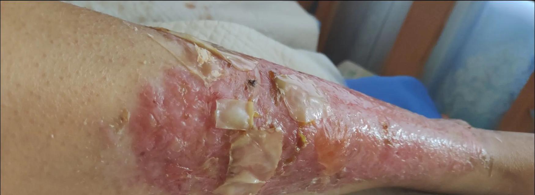 小腿结痂痊愈时间有多长？（探究小腿结痂的恢复过程及关键因素）