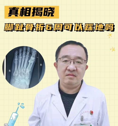 开放性骨折的康复时间及关键因素（探索开放性骨折康复的时间长短，关键因素是什么？）