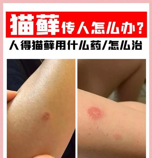 如何治愈人的猫癣？（探讨猫癣治疗的时间和方法）