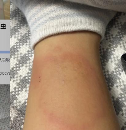 被虫咬解毒的有效方法（自然草药解毒效果显著，预防并治愈虫咬伤害）